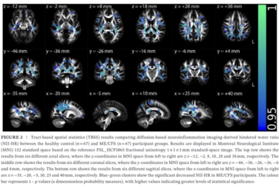 Neuroinflammation bei ME